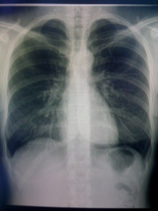 My chest x-ray. (Well a picture I took of my chest x-ray, honestly the image quality is much better than my phones!)